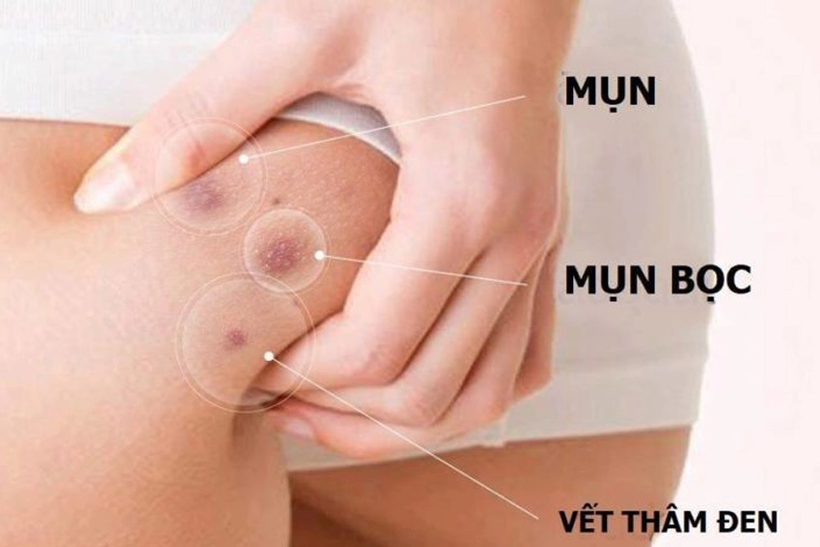 Mụn đỏ trên mông